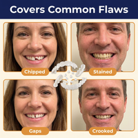 Snap-On Veneers Upper & Lower Set – Cosmetic Teeth Covers with Moldable Custom Fit, Natural White